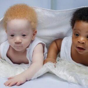 Born Minutes Apart, but One Twin's Shocking Difference Left the World Stunned!